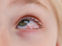 ojo con conjuntivitis --Imagen de (ICQO, 2020) https://icqo.org/2020/11/02/la-conjuntivitis-alergica-afecta-a-una-de-cada-cuatro-personas/