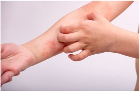 brazo con dermatitis