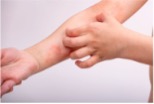dermatitis