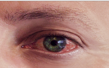 conjuntivitis